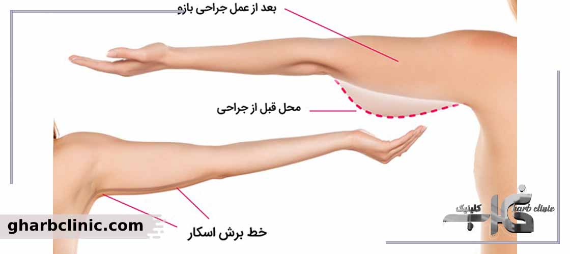 تفاوت براکیوپلاستی یا لیفت بازو با لیپوماتیک